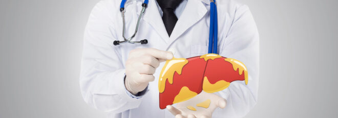 Ficatul gras sau steatoza hepatica: cauze, simptome, tratament